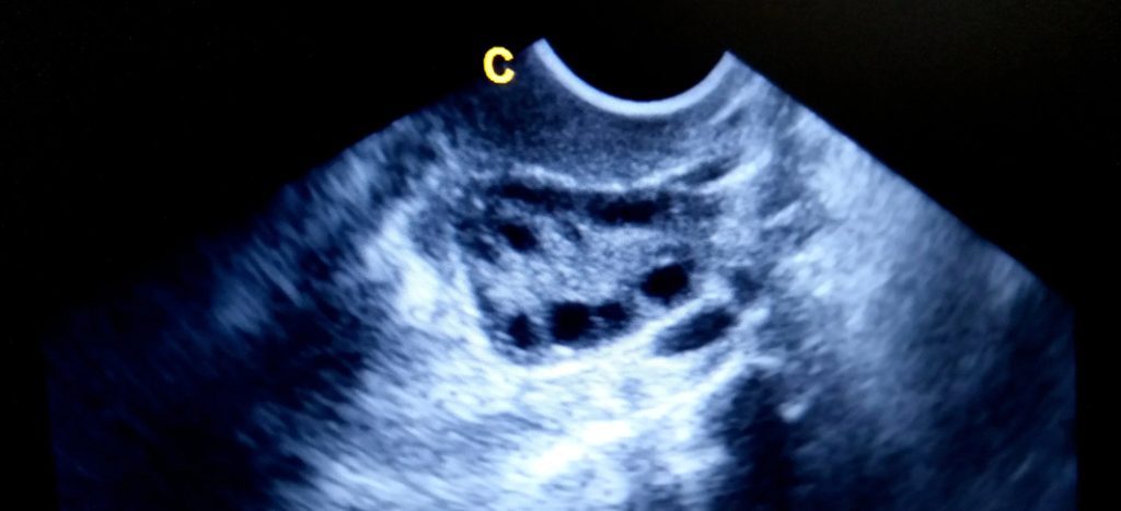 PCOS (polycystic ovary syndrome) treatment – Dr I Ferne Tan Sydney