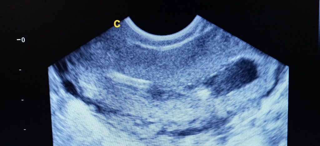 Endometrial polyps treatment – Dr I Ferne Tan Sydney