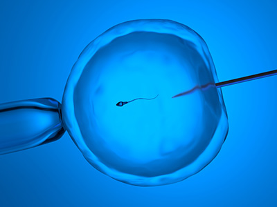 ICSI (intracytoplasmic sperm injection) treatment – Dr I Ferne Tan Sydney