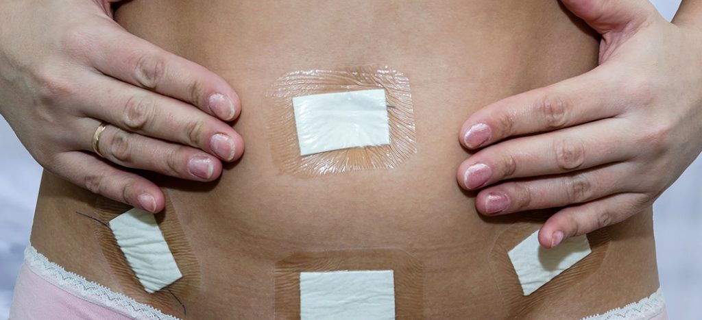 Laparoscopy keyhole surgery – Dr I Ferne Tan Sydney