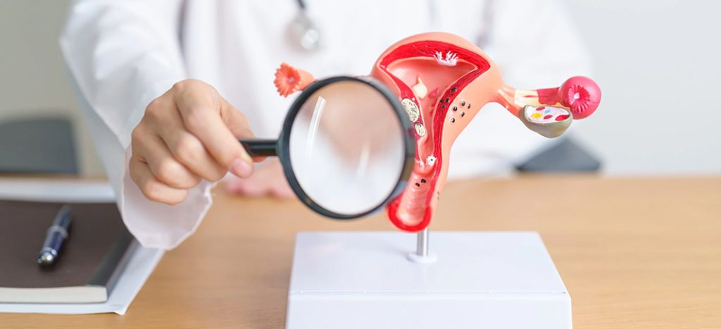 Uterine fibroids diagnosis and treatment – Dr I Ferne Tan Sydney