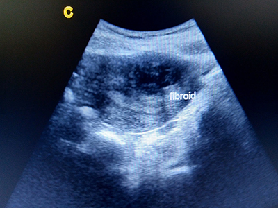 Uterine fibroids diagnosis and treatment – Dr I Ferne Tan Sydney (thumbnail)